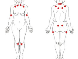 img-fibromialgia-doenca-tratada-clinica-harmony-da-dor-campo-grande