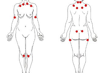 img-fibromialgia-doenca-tratada-clinica-harmony-da-dor-campo-grande