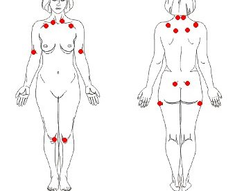 img-fibromialgia-doenca-tratada-clinica-harmony-da-dor-campo-grande