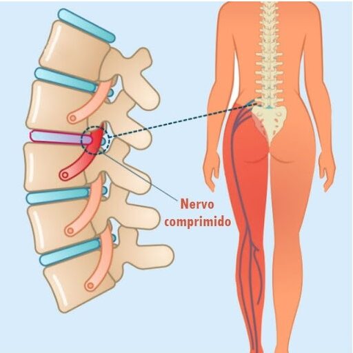 nervo-ciatico-comprimido-clinica-harmony-campo-grande-ms