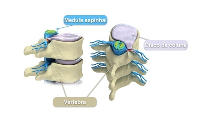 tipos-hernia-de-disco-clinica-harmony-campo-grande-ms